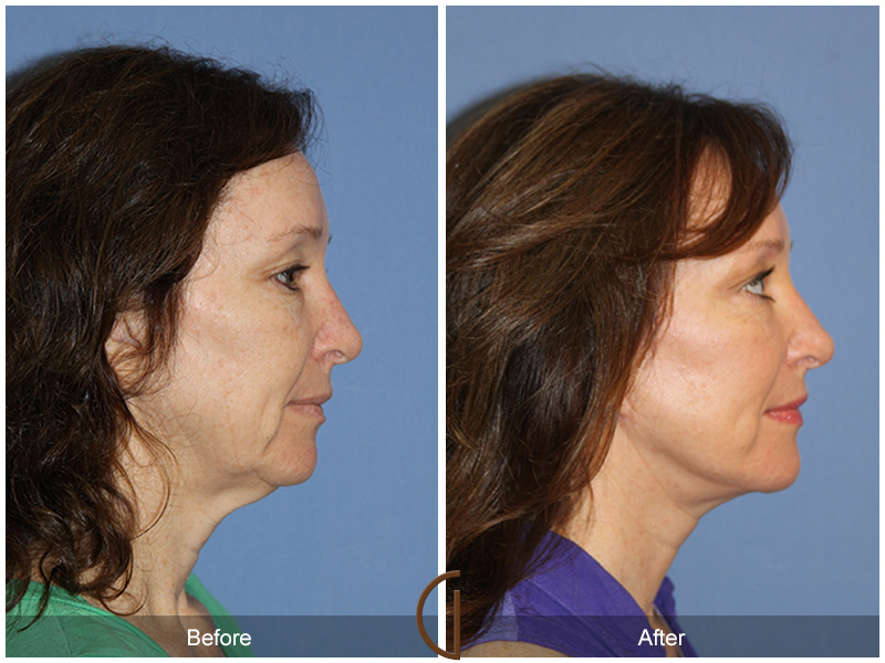 Female Facelift  Before & After Image