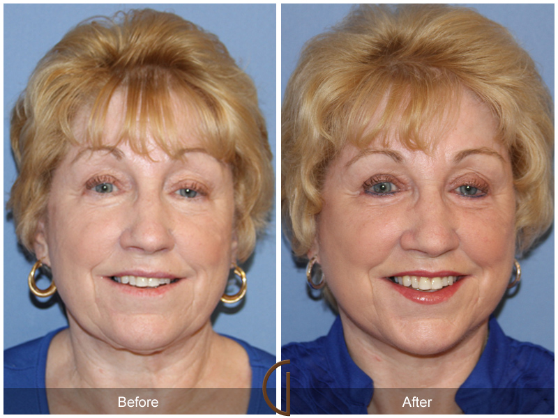 Female Facelift  Before & After Image