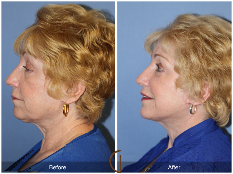 Female Facelift  Before & After Image