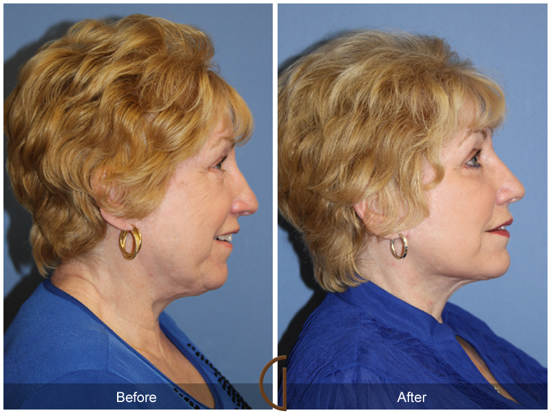 Female Facelift  Before & After Image