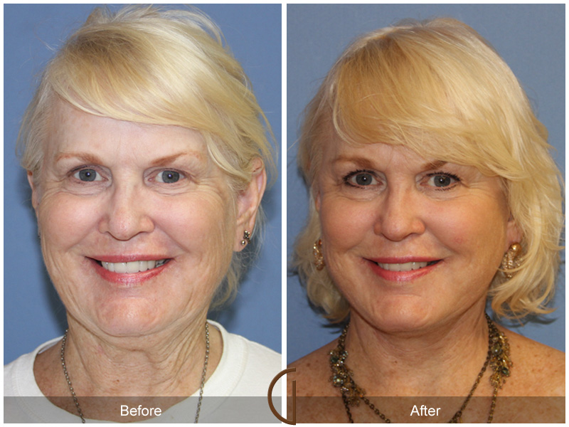 Female Facelift  Before & After Image