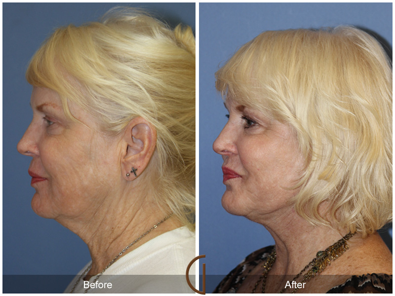 Female Facelift  Before & After Image