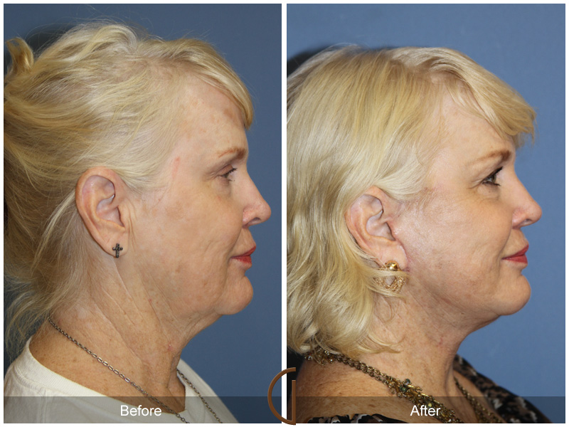 Female Facelift  Before & After Image