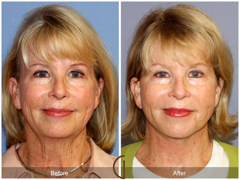 Female Facelift  Before & After Image