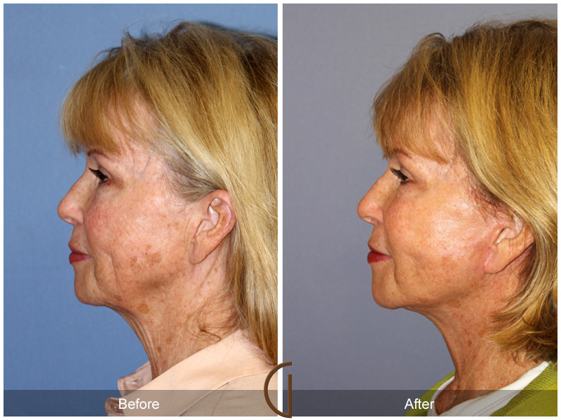 Female Facelift  Before & After Image