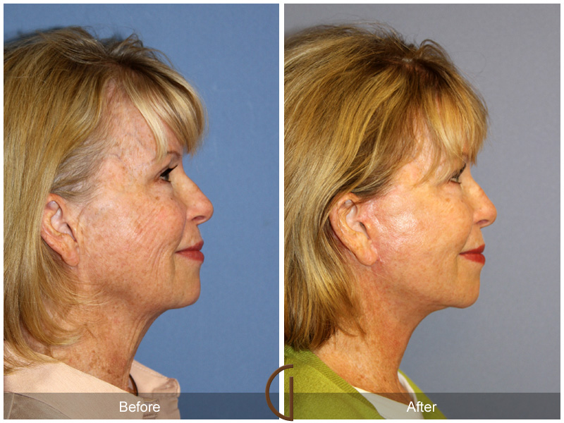 Female Facelift  Before & After Image