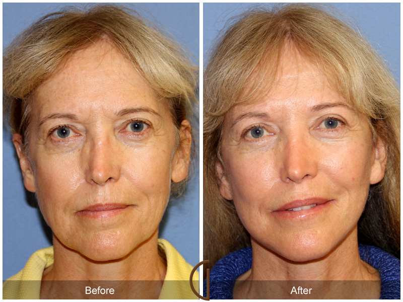 Female Facelift  Before & After Image