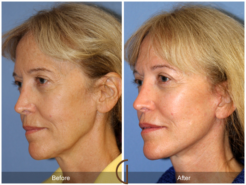 Female Facelift  Before & After Image