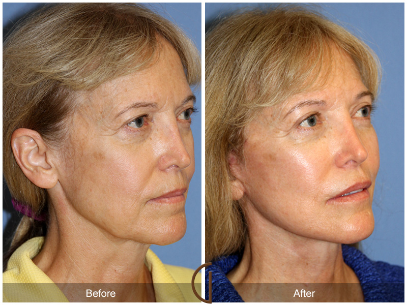 Female Facelift  Before & After Image