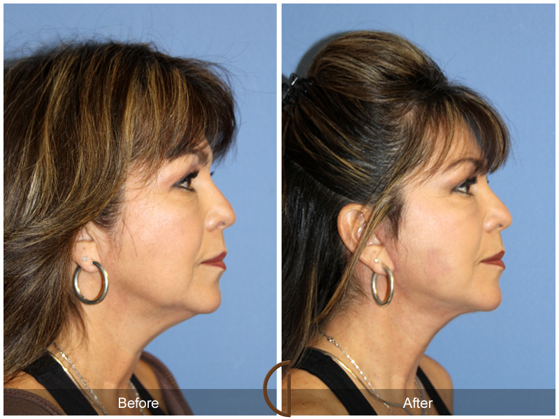 Female Facelift  Before & After Image