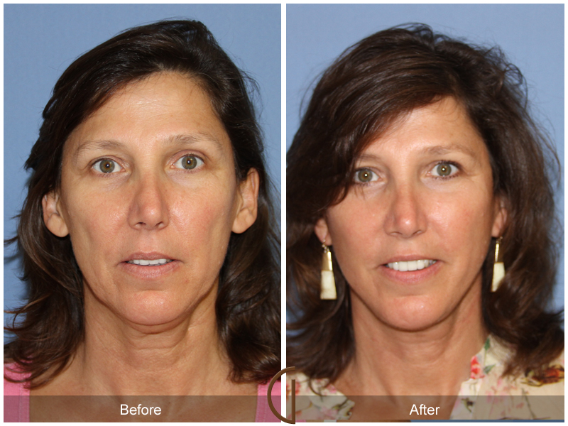 Female Facelift  Before & After Image