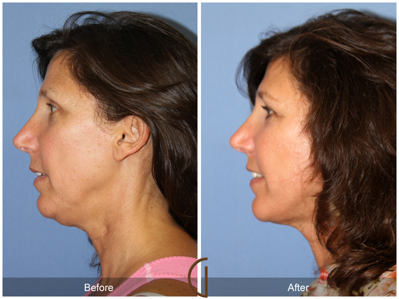 Female Facelift  Before & After Image