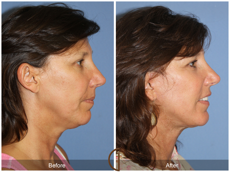 Female Facelift  Before & After Image