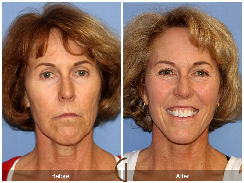 Female Facelift  Before & After Image