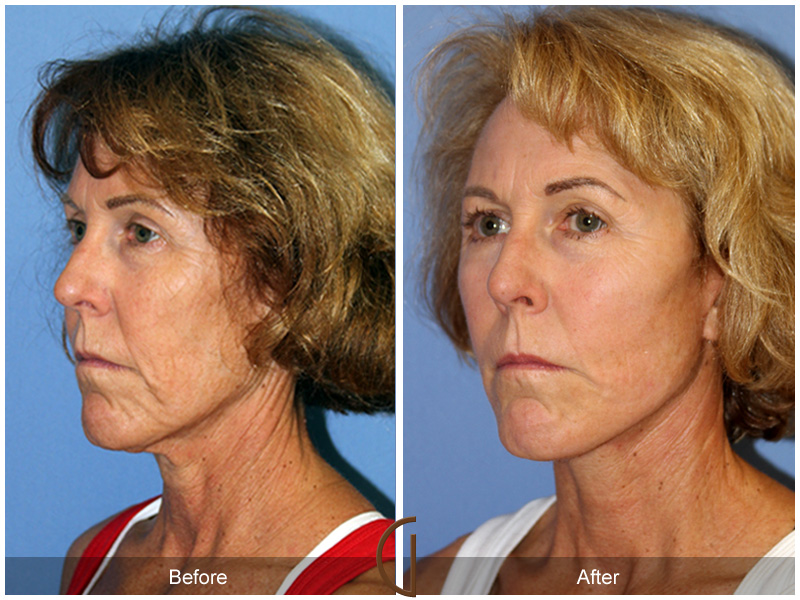 Female Facelift  Before & After Image