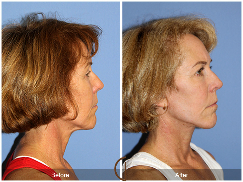 Female Facelift  Before & After Image
