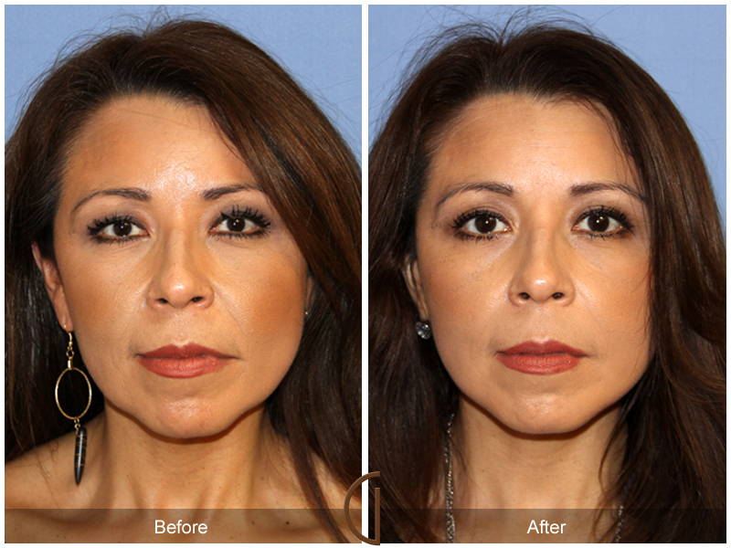 Female Facelift  Before & After Image