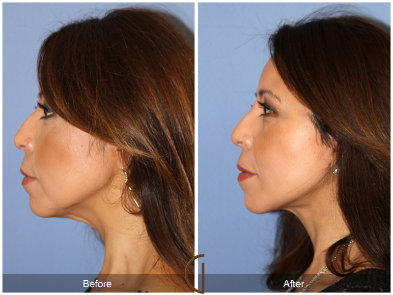 Female Facelift  Before & After Image