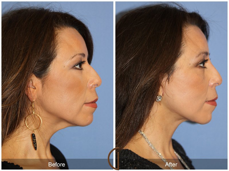 Female Facelift  Before & After Image