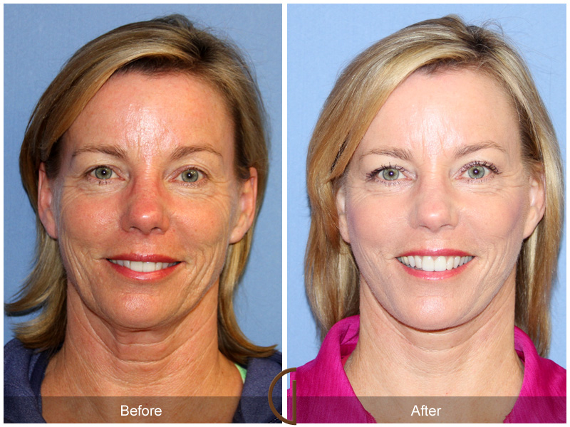 Female Facelift  Before & After Image