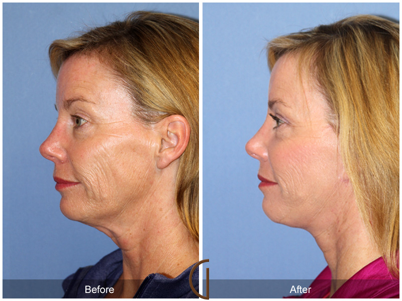 Female Facelift  Before & After Image