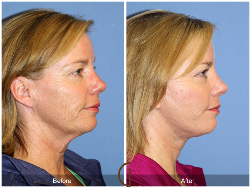 Female Facelift  Before & After Image