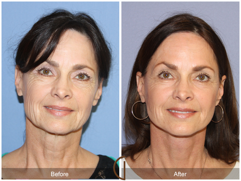 Female Facelift  Before & After Image