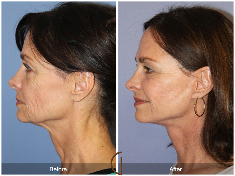 Female Facelift  Before & After Image