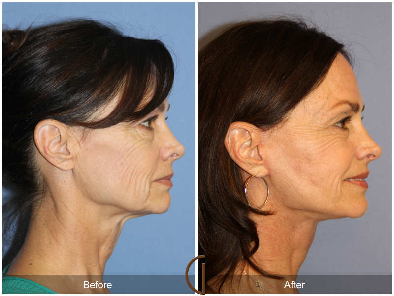 Female Facelift  Before & After Image