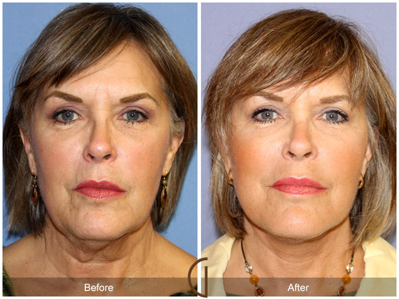 Female Facelift  Before & After Image