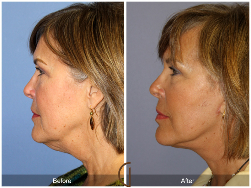 Female Facelift  Before & After Image