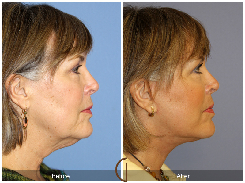 Female Facelift  Before & After Image