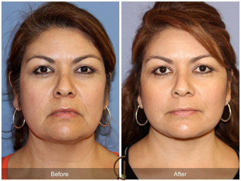 Female Facelift  Before & After Image