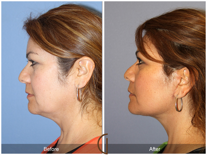 Female Facelift  Before & After Image