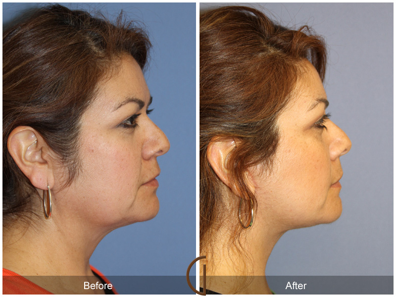 Female Facelift  Before & After Image