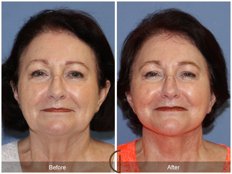 Female Facelift  Before & After Image