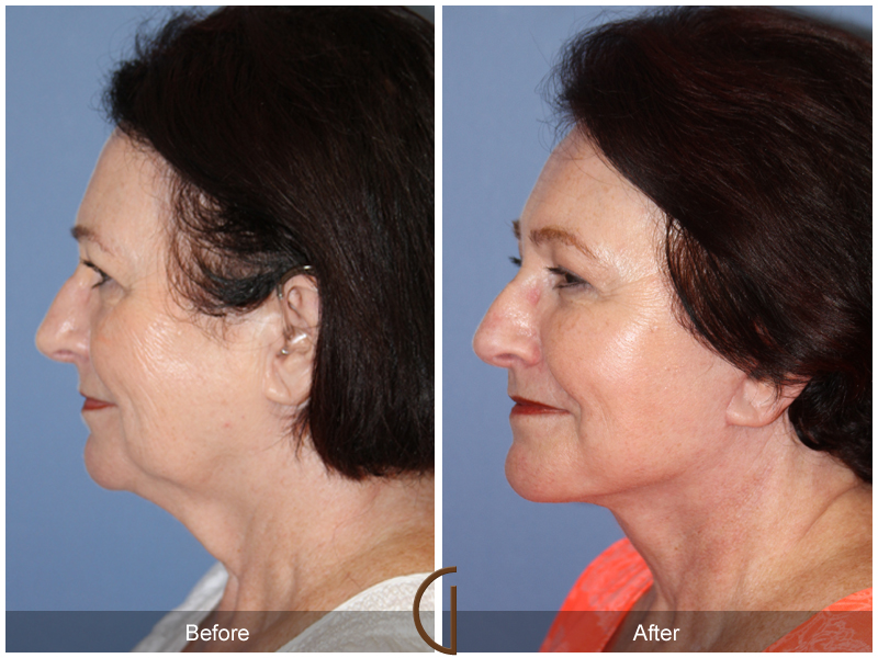 Female Facelift  Before & After Image