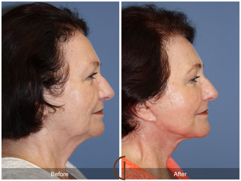 Female Facelift  Before & After Image