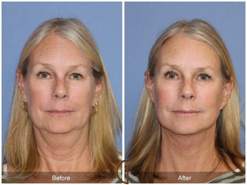 Female Facelift  Before & After Image