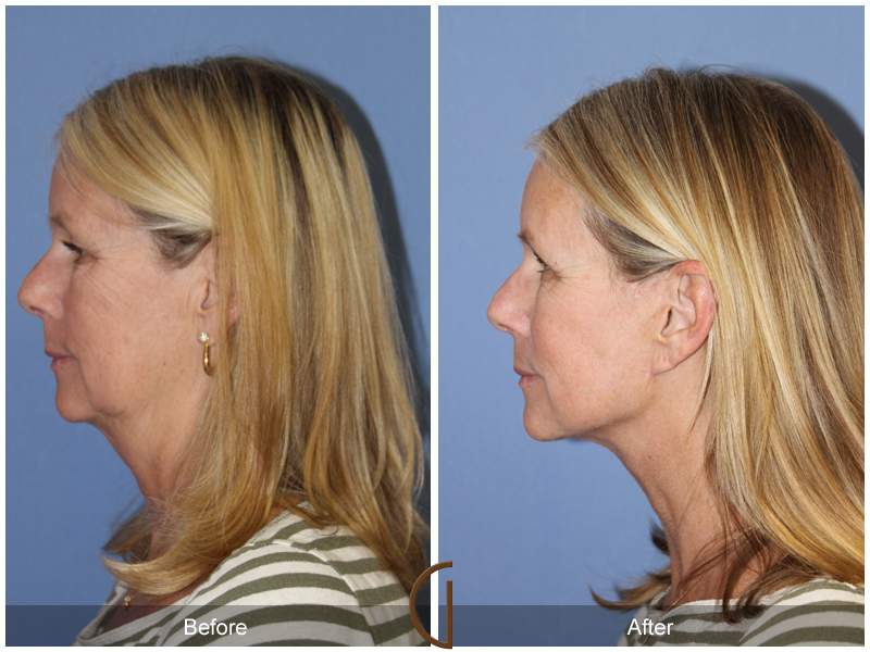 Female Facelift  Before & After Image