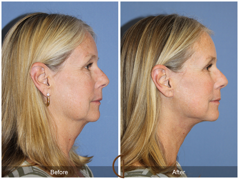 Female Facelift  Before & After Image