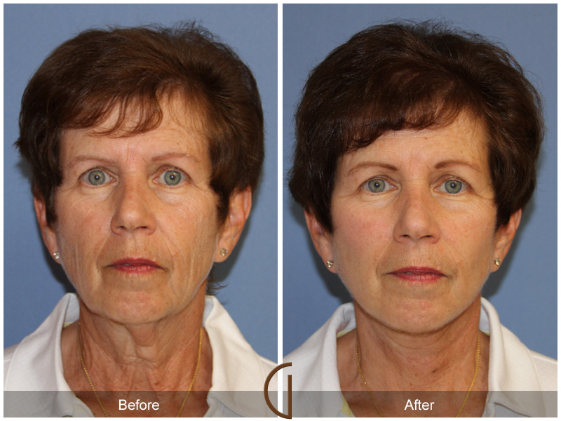 Female Facelift  Before & After Image