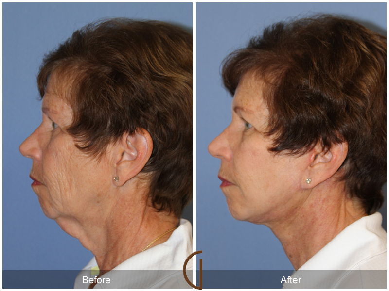 Female Facelift  Before & After Image