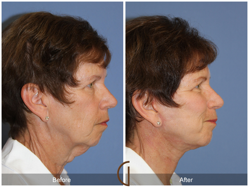 Female Facelift  Before & After Image