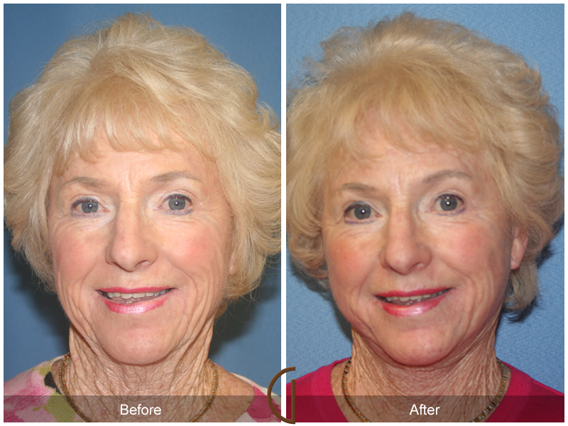 Female Facelift  Before & After Image