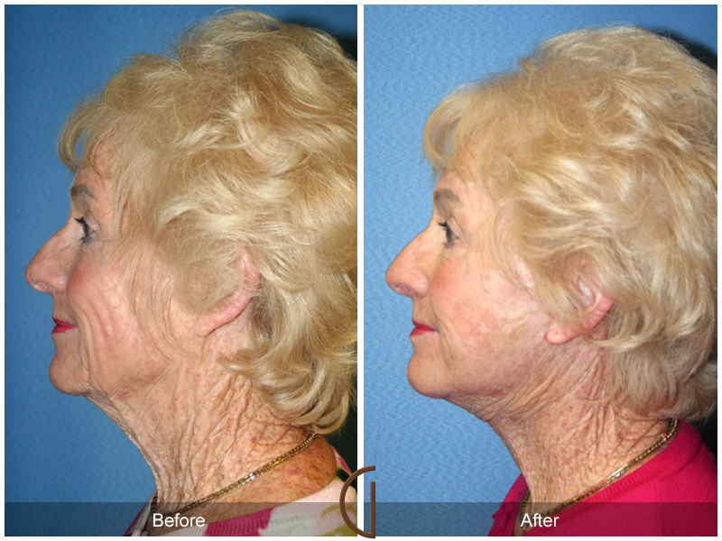 Female Facelift  Before & After Image