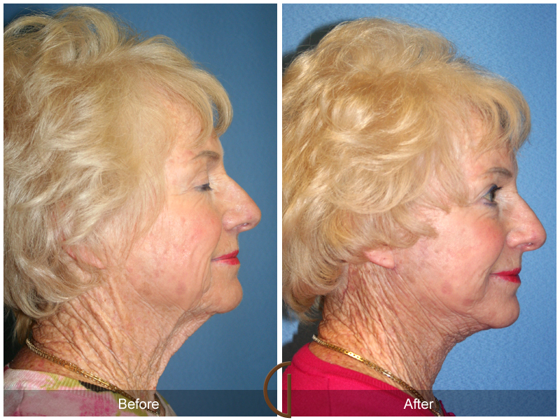 Female Facelift  Before & After Image