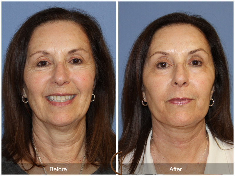 Female Facelift  Before & After Image