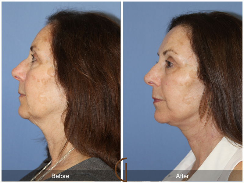 Female Facelift  Before & After Image