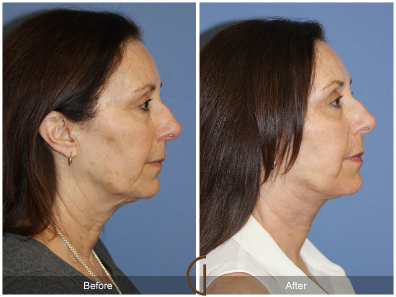 Female Facelift  Before & After Image